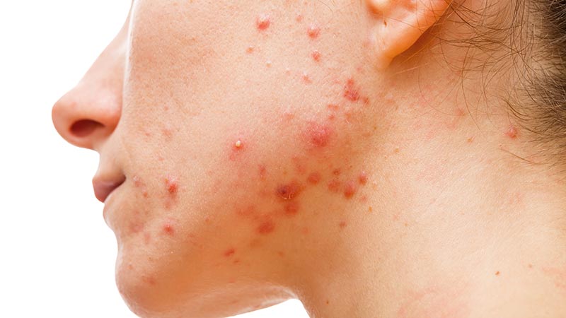 ¿Qué alimentos agravan el acné?